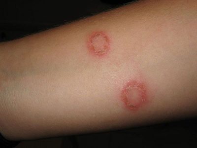pictures of ringworm
